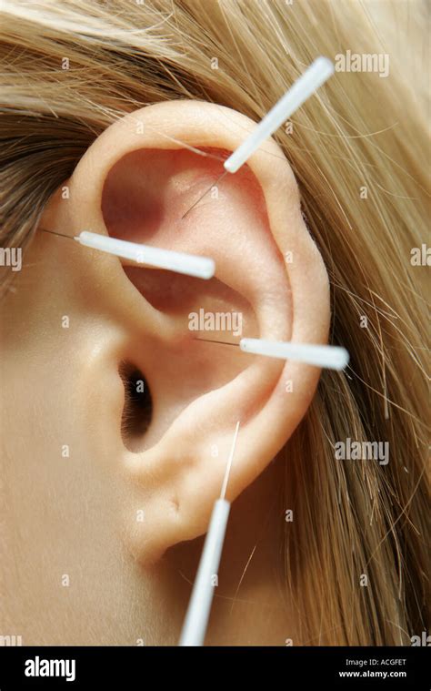Acupuncture In The Ear At Shirley Ashley Blog Acupuncture In The Ear At Shirley Ashley Blog