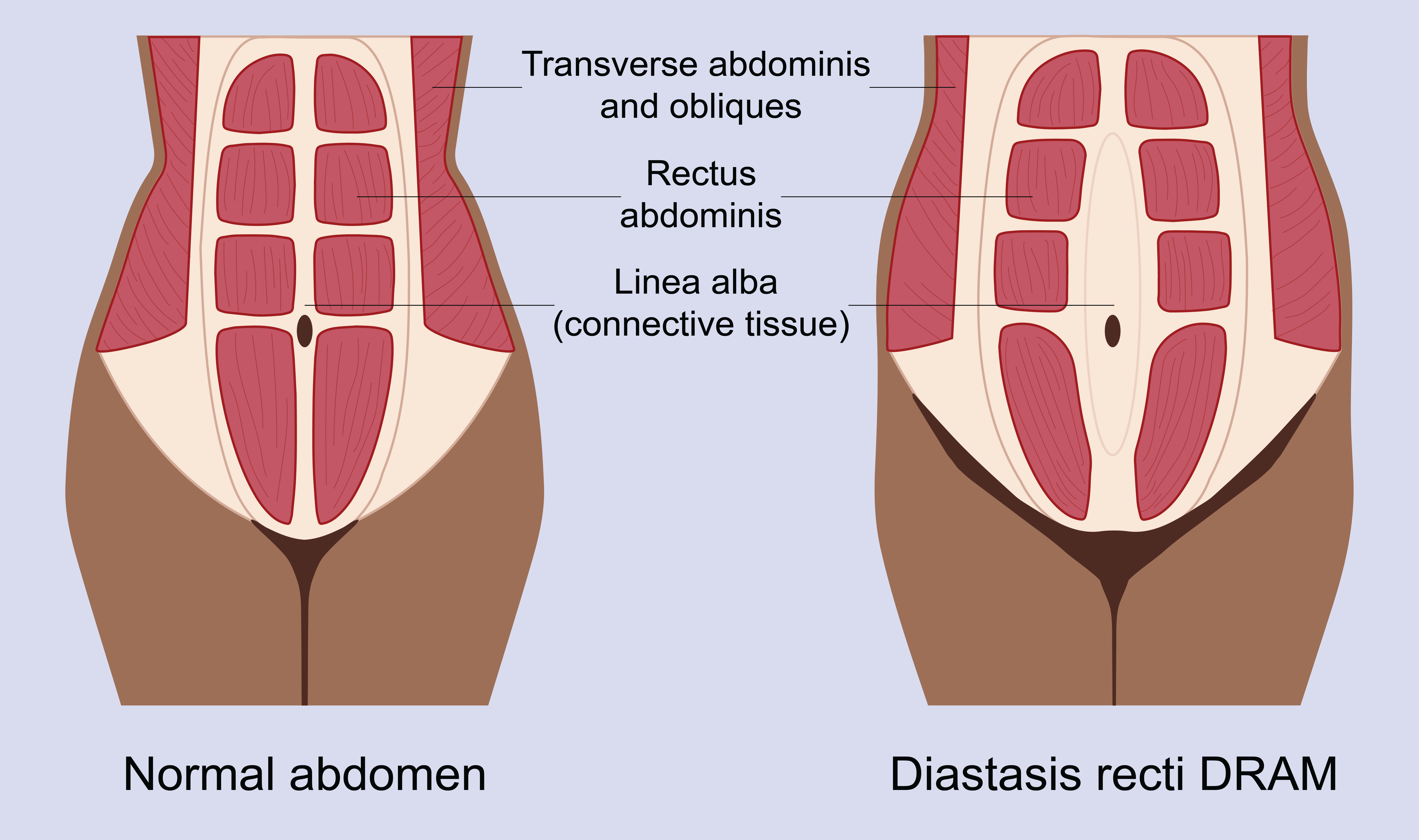 5 Quick Fixes for Diastasis Recti