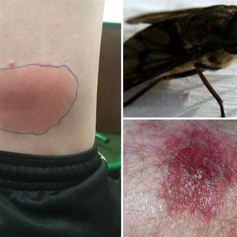 Blow Fly Bite: 5 Facts You Must Know