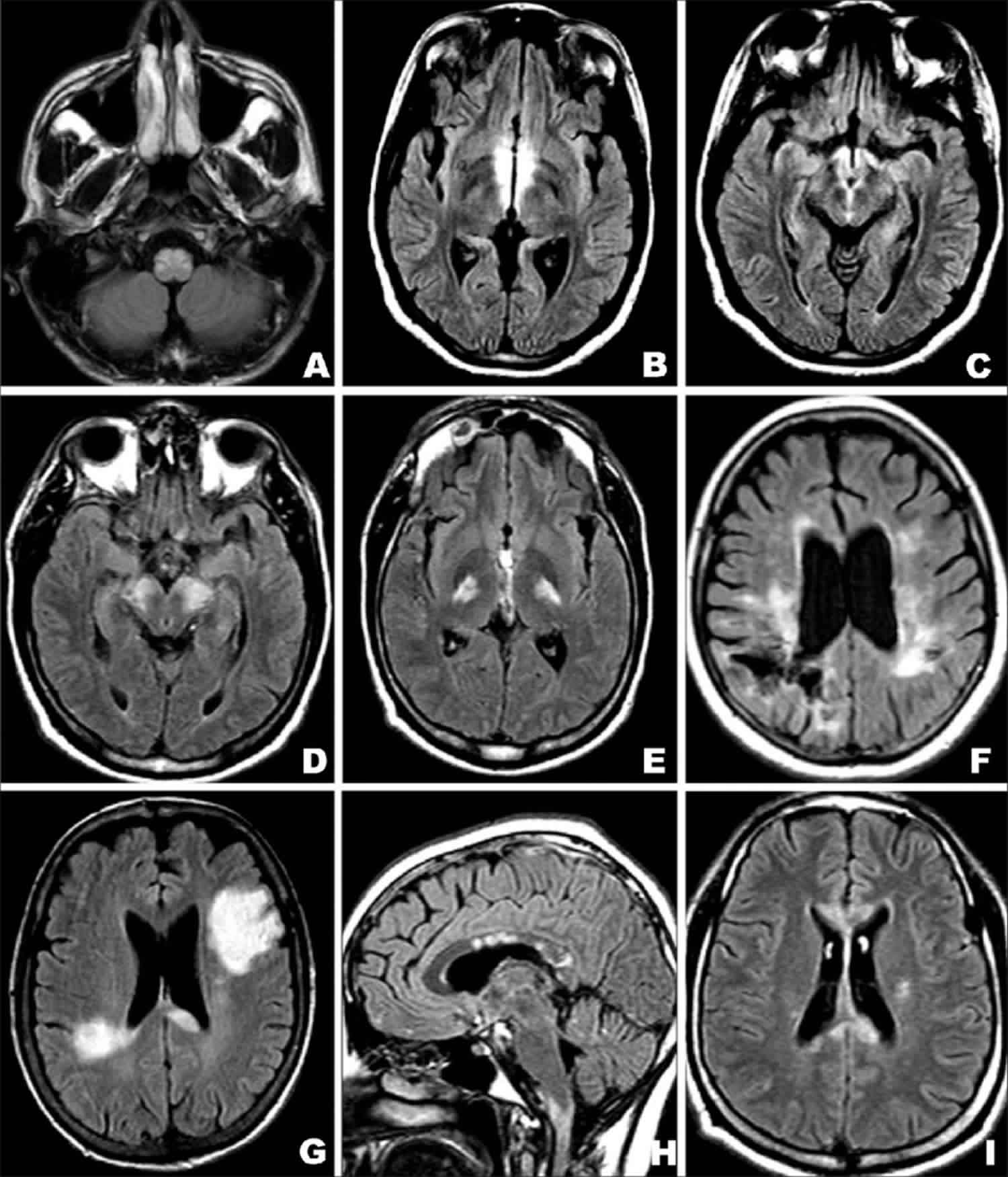 5 Symptoms of Brain Lesions in Dogs