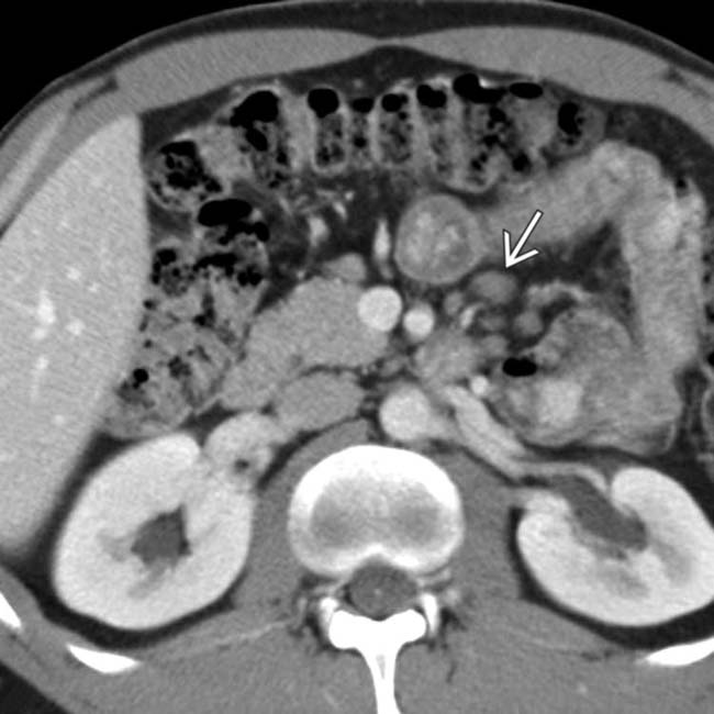 Understanding Celiac Sprue: 5 Key Facts