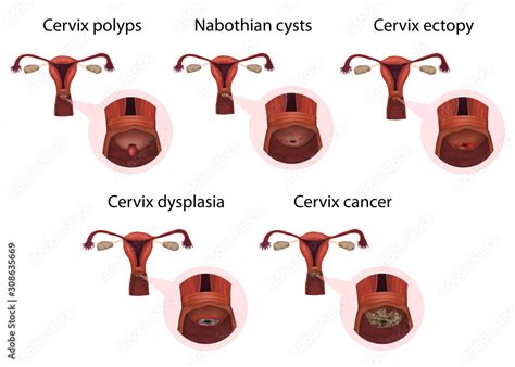 10 Cervix Abnormality Signs: Recognize and Act