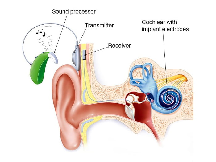 Understanding Cochlear Implant Costs: A Guide Understanding Cochlear Implant Costs: A Guide