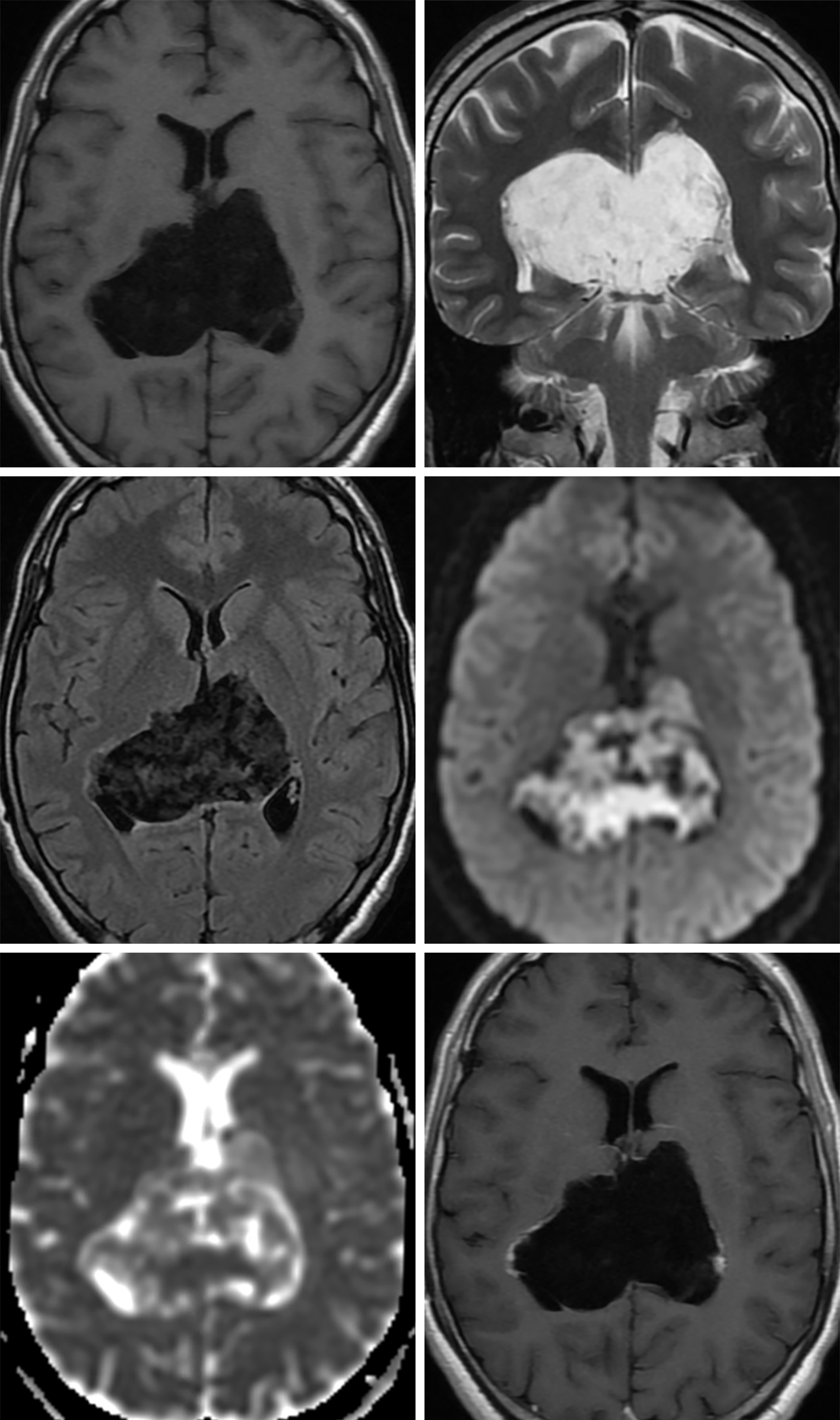 Understanding Brain Cysts: 4 Key Insights