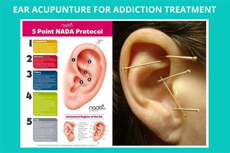 Ear Acupuncture Addiction Ear Acupuncture Addiction