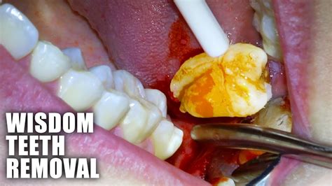 Understanding Wisdom Tooth Emergencies: Swift Action Needed