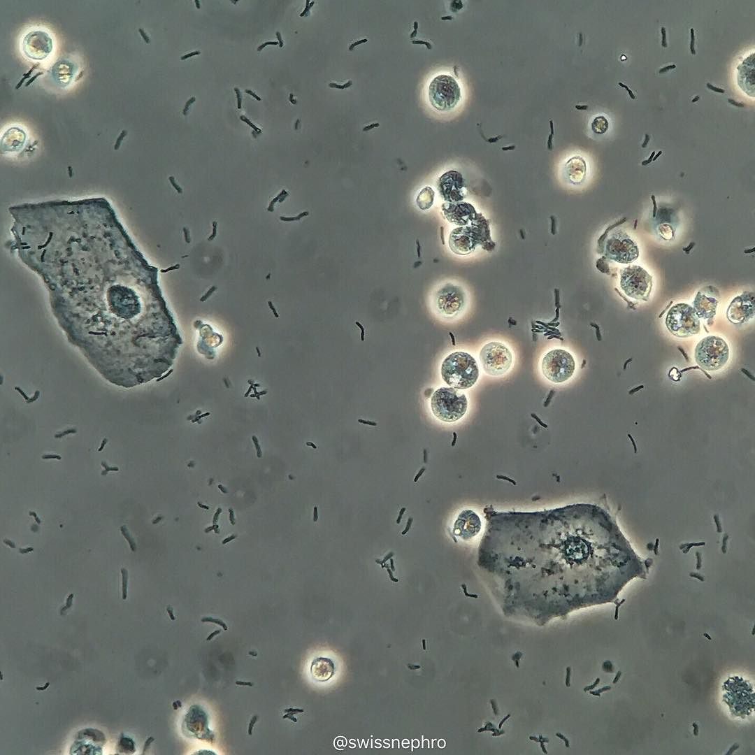 Epithelial Cells: Unraveling Urine's Secret Agents Epithelial Cells: Unraveling Urine's Secret Agents