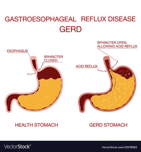 Gerd Gastroesophageal Reflux Disease Tambaram Medical Center Gerd Gastroesophageal Reflux Disease Tambaram Medical Center