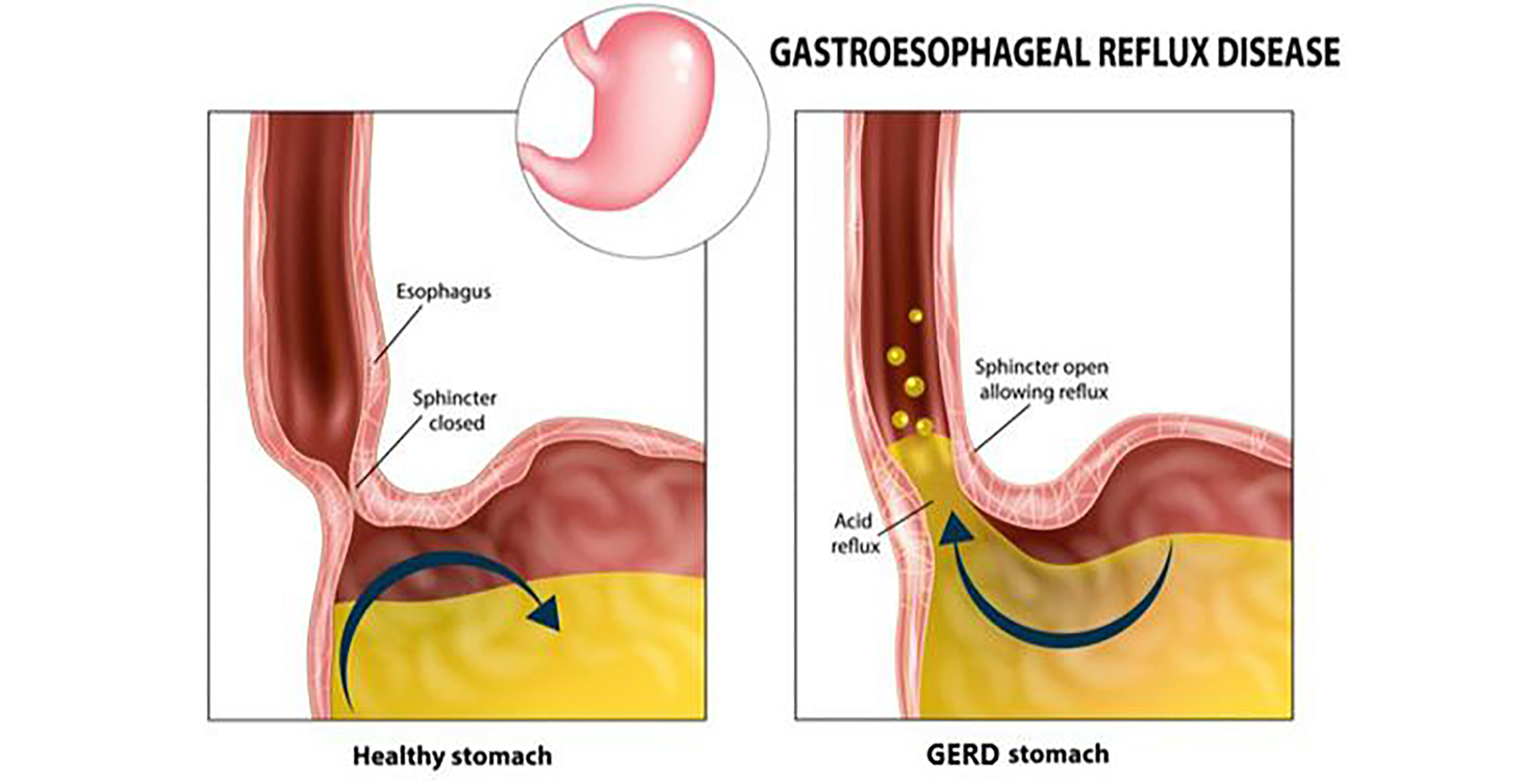 Healthy Her Gastroesophageal Reflux Disease Healthy Her Gastroesophageal Reflux Disease