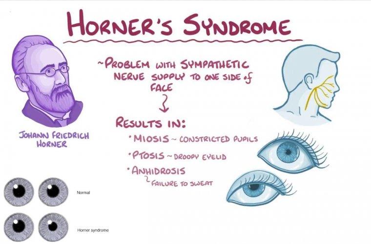 Horner S Syndrome Causes Symptoms And Treatment Horner S Syndrome Causes Symptoms And Treatment