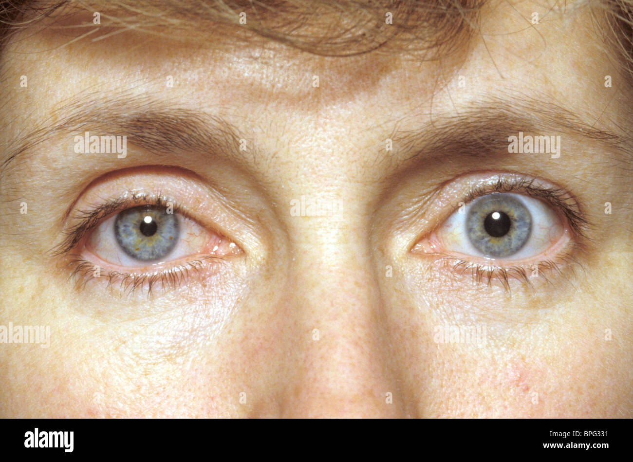 Horner S Syndrome Cranial Nerve Horner S Syndrome Cranial Nerve