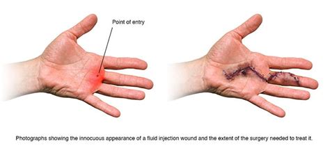Hydraulic Fluid: A Dangerous Skin Invader
