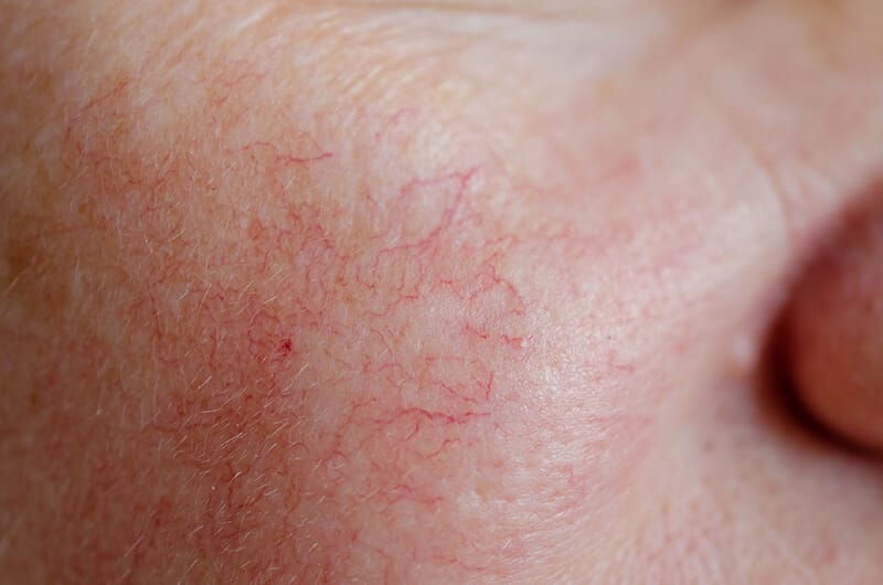 Understanding the ICD 10 for Spider Veins