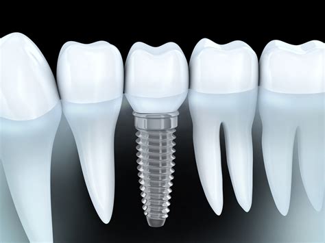 Top Implant Dentists Near Me: Find Your Perfect Smile