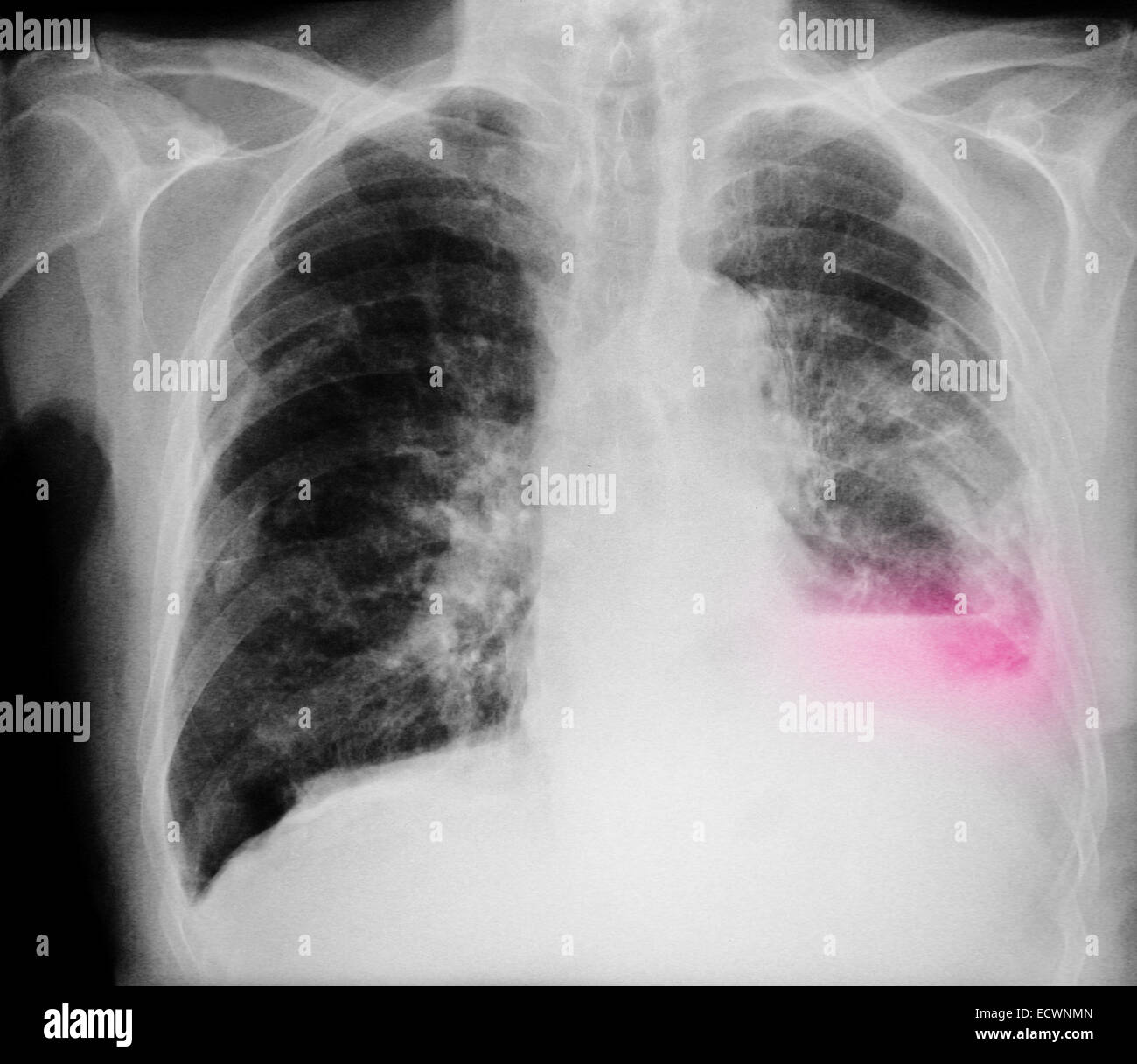 Infiltrates On Chest X Ray Infiltrates On Chest X Ray