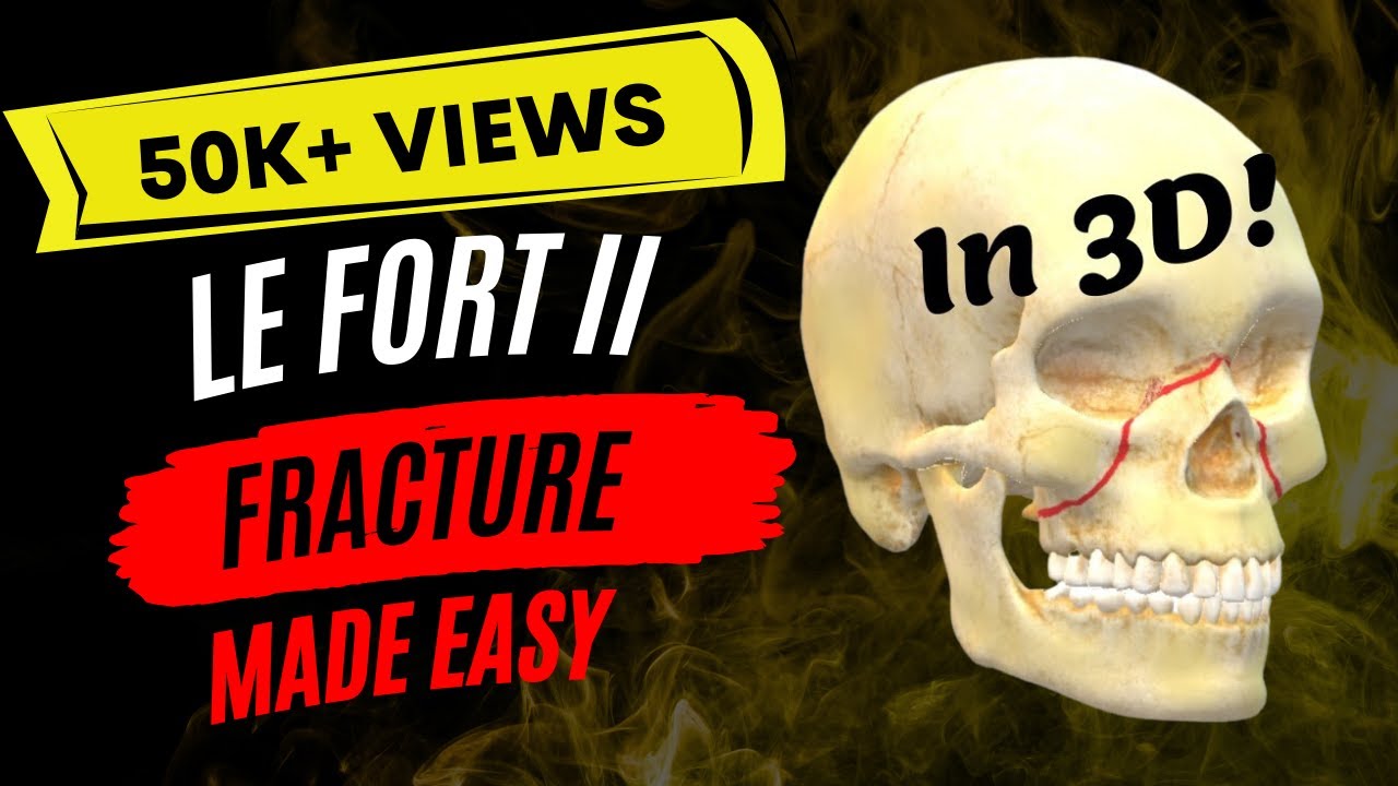 Understanding Le Fort Fractures: 5 Key Facts