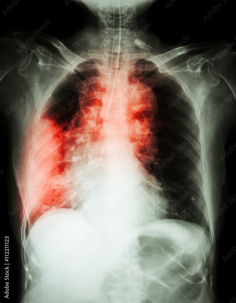 Lung Cancer Film Chest X Ray Show Right Lung Mass Wide Mediastinum Lung Cancer Film Chest X Ray Show Right Lung Mass Wide Mediastinum