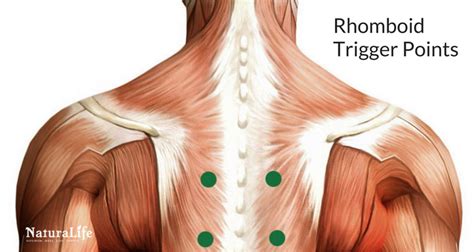 Melt Away Headaches With Trigger Point Therapy Naturalife Melt Away Headaches With Trigger Point Therapy Naturalife