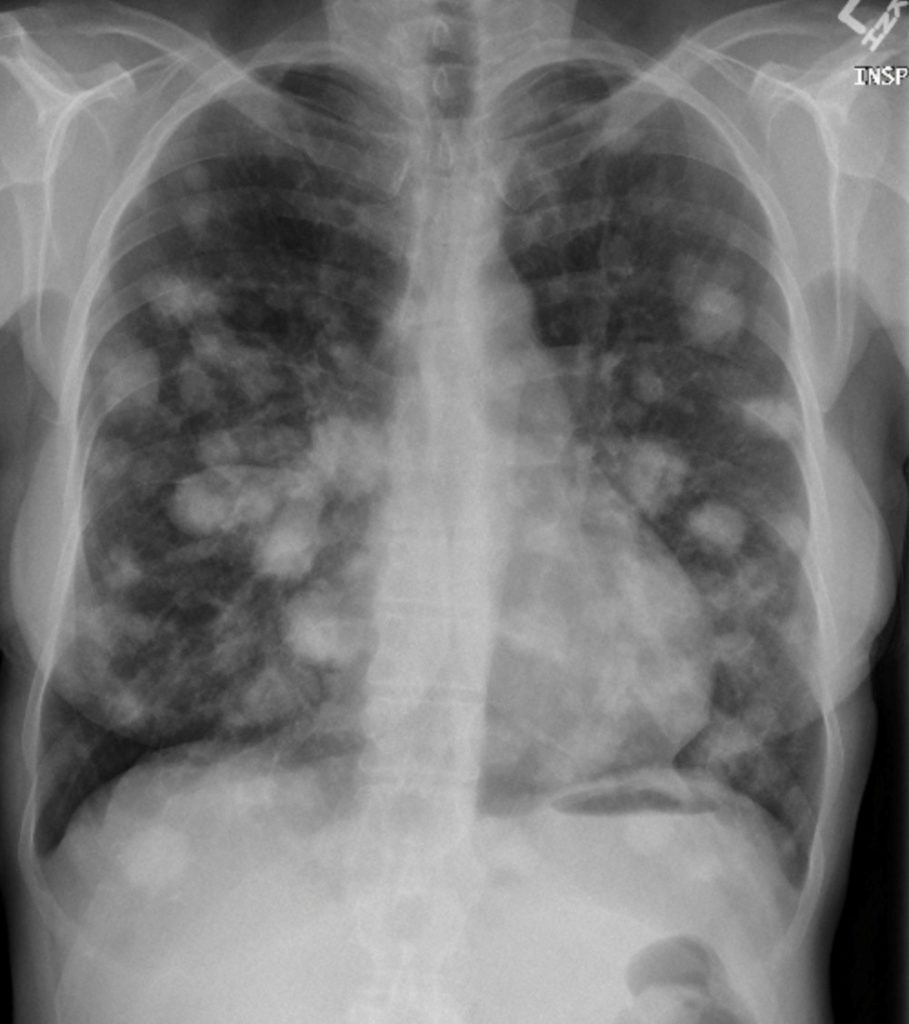 Multiple Lung Nodules And A Large Amount Of Multiloculated Pleural Multiple Lung Nodules And A Large Amount Of Multiloculated Pleural