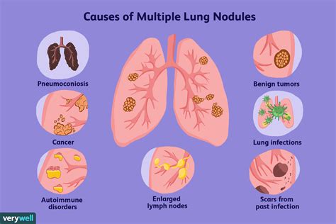 Multiple Pulmonary Nodules: 5 Key Insights Multiple Pulmonary Nodules: 5 Key Insights