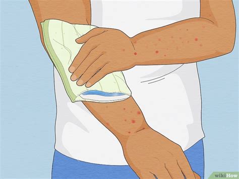 3 Ways to Soothe No-See-Um Bites 3 Ways to Soothe No-See-Um Bites