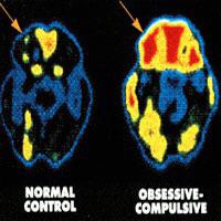 Brain Scans: Uncovering OCD's Secrets