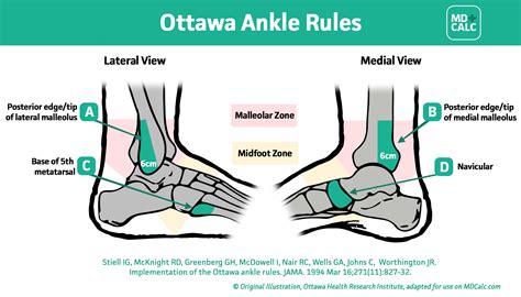 Ottawa Ankle Rules: A Simple Guide