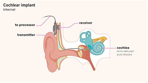 Parts Of A Cochlear Implant Diagram Parts Of A Cochlear Implant Diagram