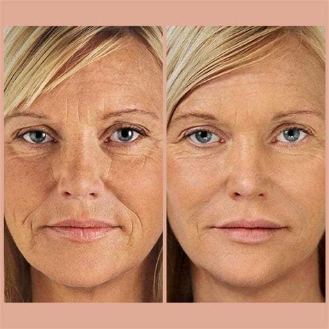 Pdo Thread Lifts How Long Do They Last Hamilton Skin Clinic