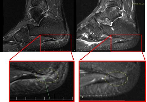 Plantar Fascia Tear: 5 Ways to Heal