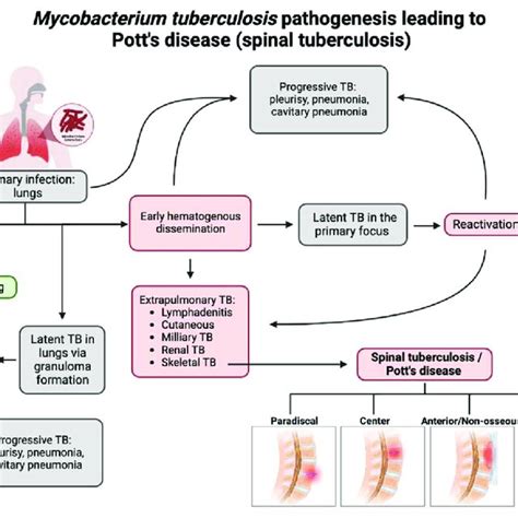 Pots Disease: Understanding Your Lifespan Pots Disease: Understanding Your Lifespan