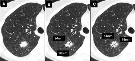 Recommendations For Measuring Pulmonary Nodules At Ct A Statement From Recommendations For Measuring Pulmonary Nodules At Ct A Statement From