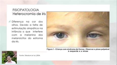 Sintomas De S Ndrome De Horner Braincp Sintomas De S Ndrome De Horner Braincp