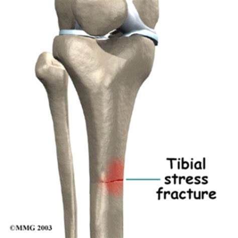 Understanding Stress Fractures and Shin Splints
