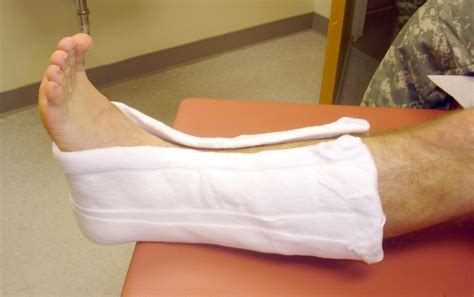 Sugar Tong Splint Ankle Sugar Tong Splint Ankle