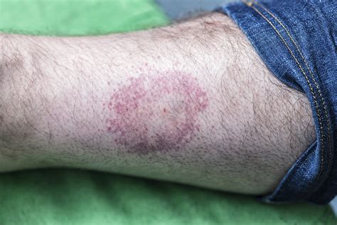 Symptoms Of Untreated Lyme Disease Symptoms Of Untreated Lyme Disease