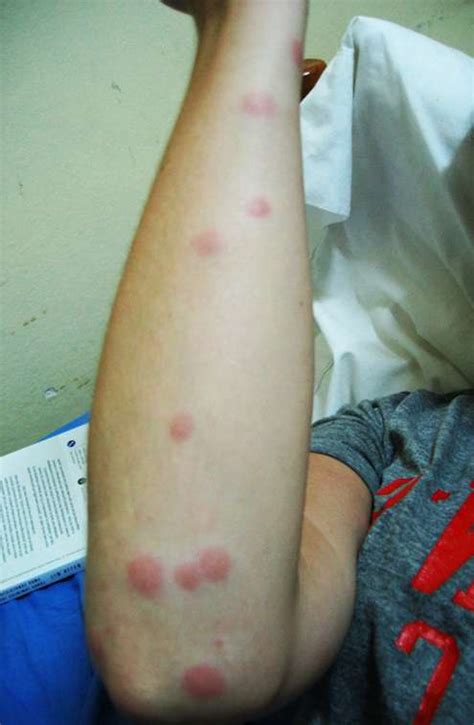 5 Signs of Termite Bites on Humans