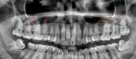 Tooth Pain Sinusitis Mis Diagnosis Chapter 2 Dentistry And Tooth Pain Sinusitis Mis Diagnosis Chapter 2 Dentistry And