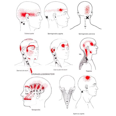 Target Trigger Points at the Skull's Base