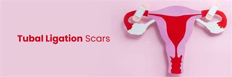Understanding Tubal Ligation Scars: A Guide