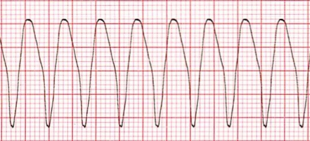 Ventricular Tachycardia Diagnosis Of Broad Qrs Complex Tachycardia Heart Ventricular Tachycardia Diagnosis Of Broad Qrs Complex Tachycardia Heart