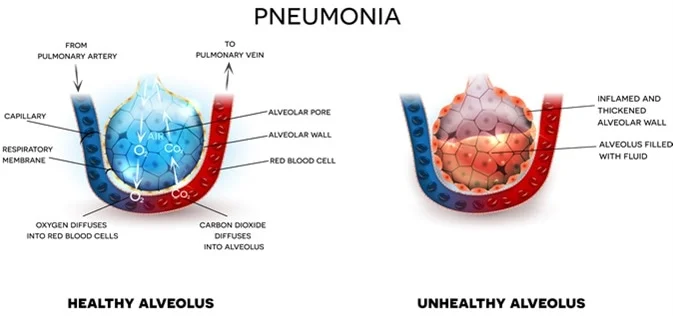 Symptoms of Walking Pneumonia: 8 Signs Symptoms of Walking Pneumonia: 8 Signs