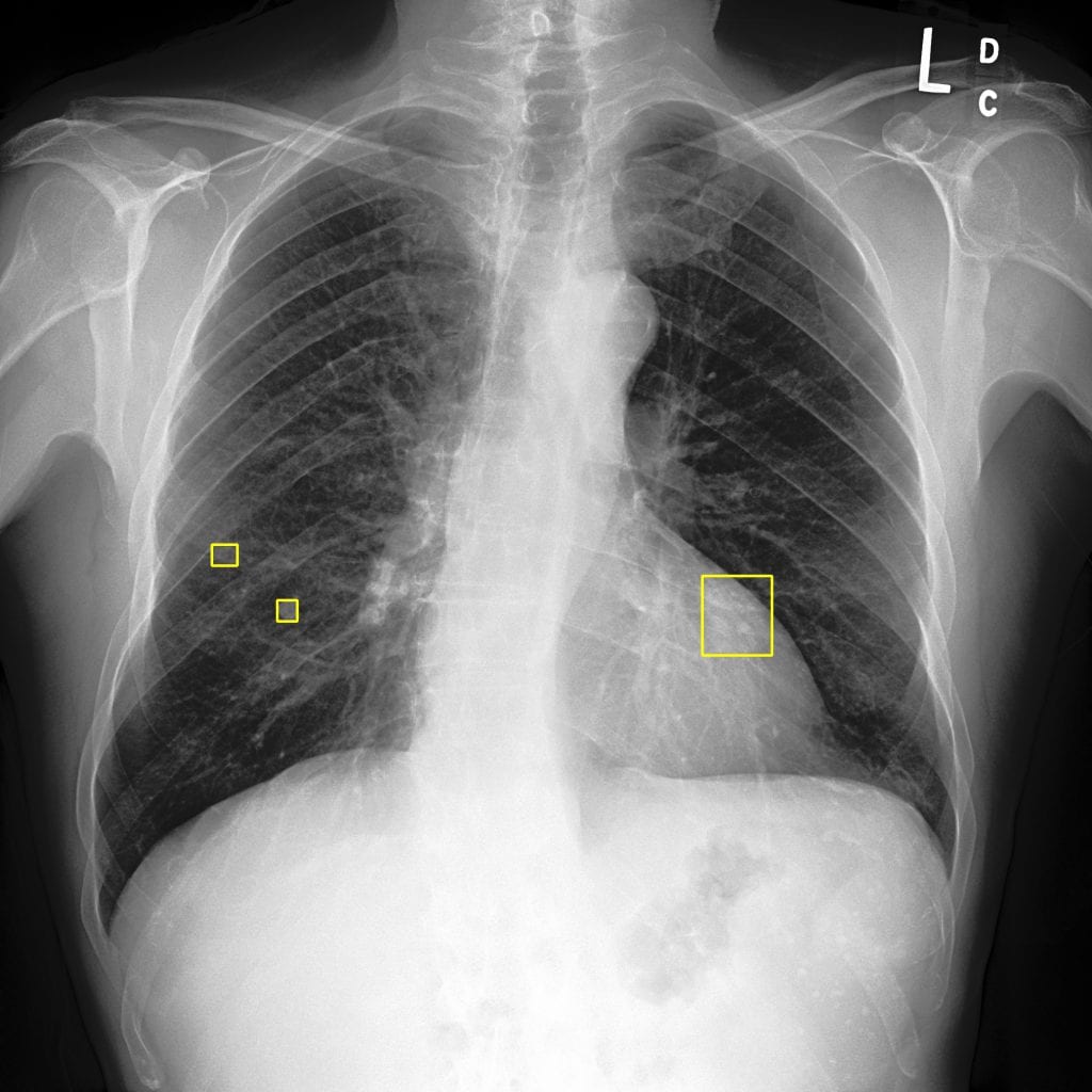 What Is A Chest Nodule At Alan Moore Blog