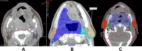 Xerostomia: 4 ICD-10 Insights
